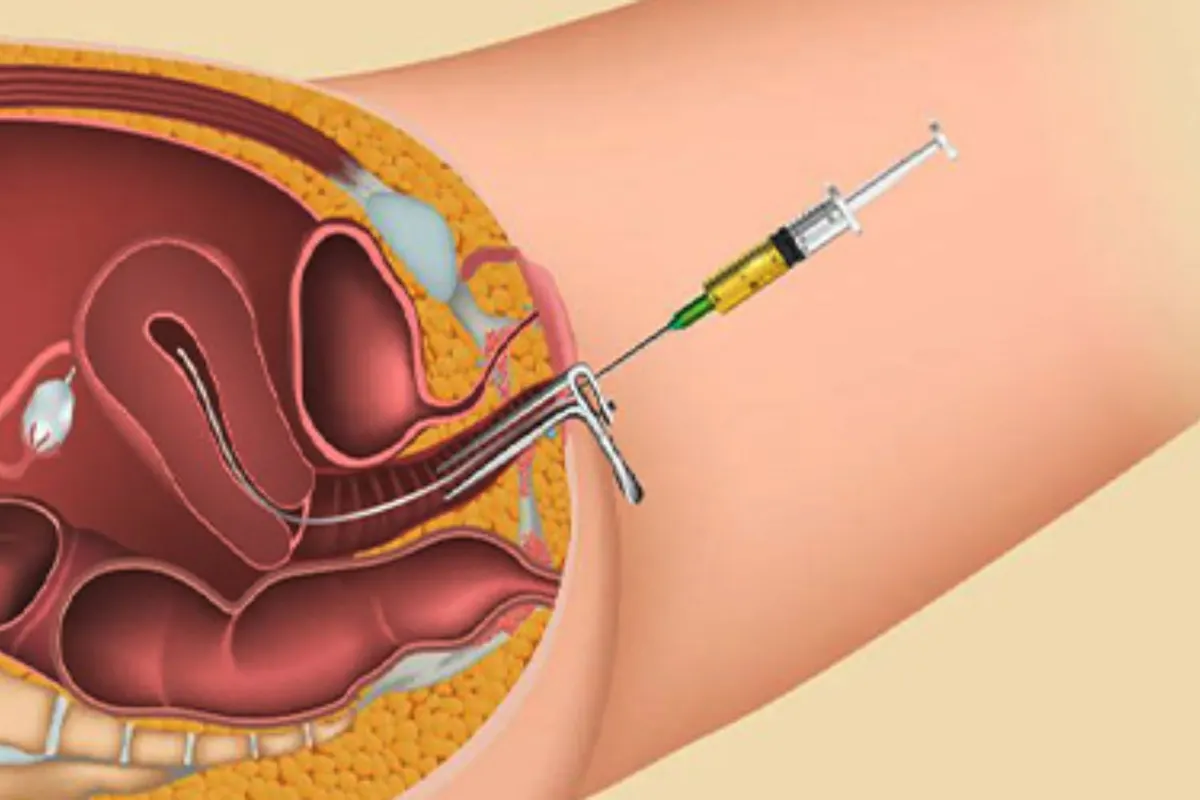 Intrauterine insemination IUI fertility treatment at AnuSri Hospitals Secunderabad