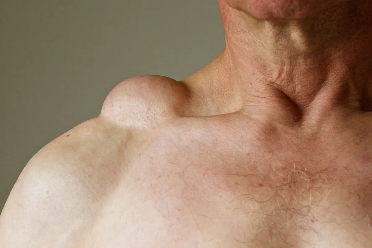 Lipoma evaluation and surgical removal at AnuSri Hospitals Secunderabad Hyderabad