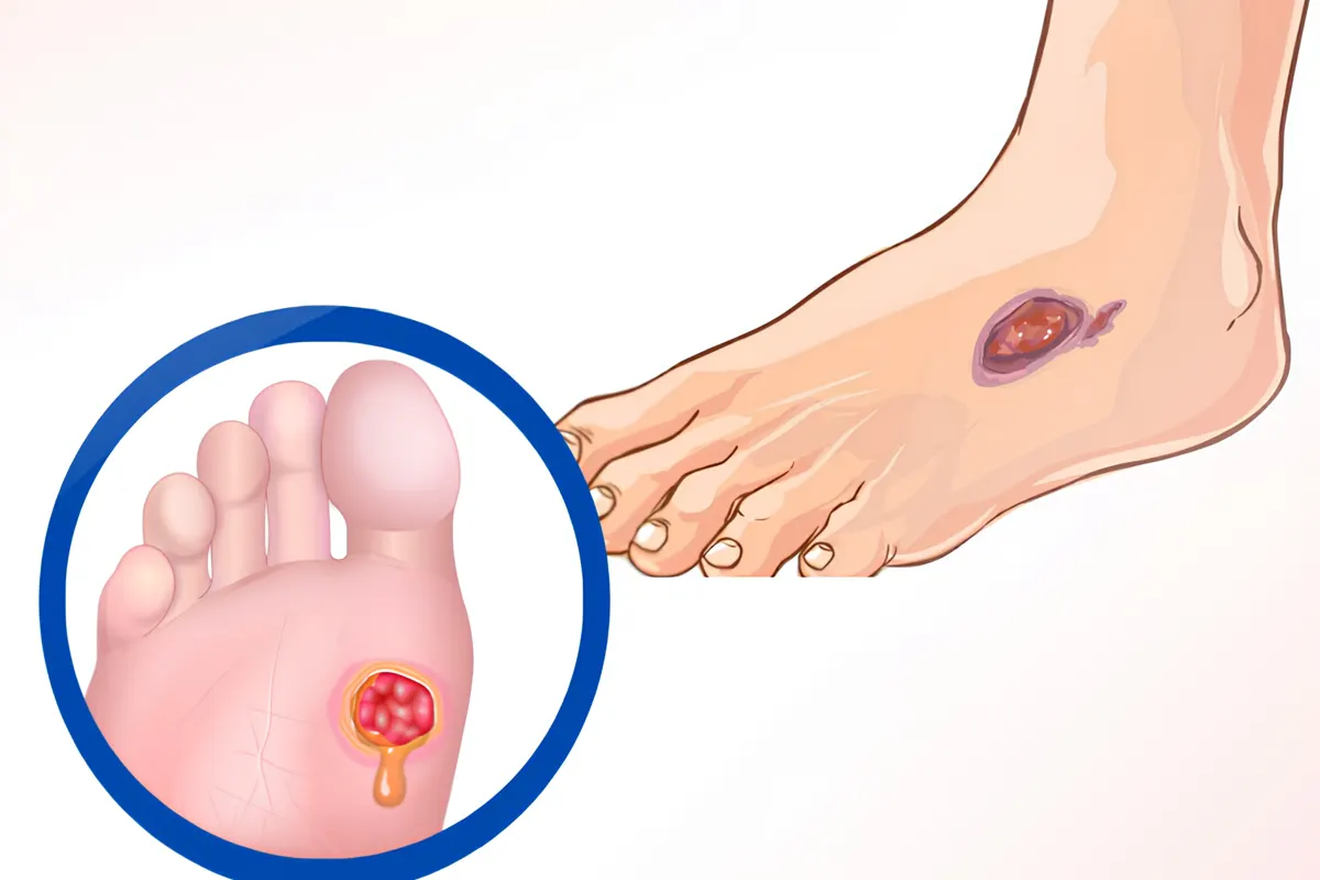 Non-healing chronic wound care at AnuSri Hospitals Secunderabad Hyderabad