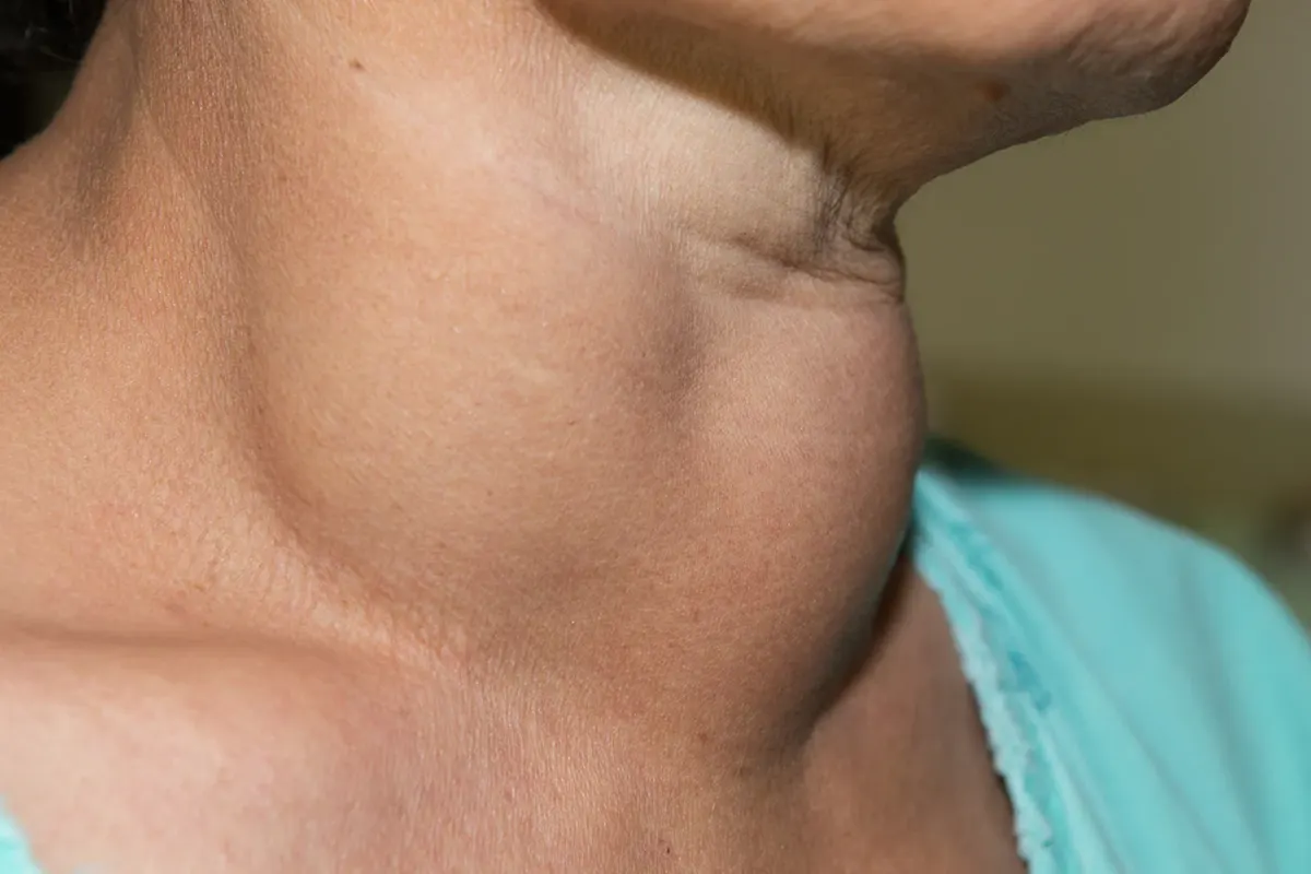 Thyroid swellings and nodule evaluation at AnuSri Hospitals Secunderabad Hyderabad